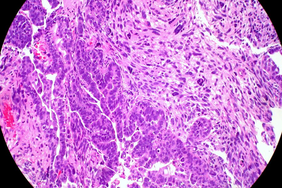 tumor endometri_Ed Uthman