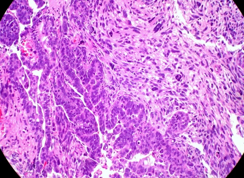 tumor endometri_Ed Uthman